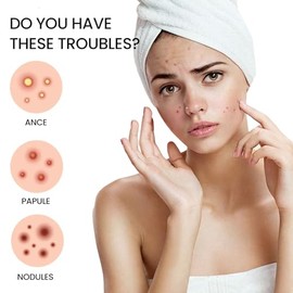 Parches para Espinillas y Acné Hidrocoloides Invisibles de 200 Piezas Tratamiento Rápido de Imperfecciones y Absorción de Grasa Facial