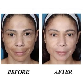 Melasma, Hiperpigmentación Piel Oscura, Manchas,frasco 50 Ml
