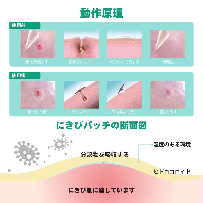 ACOTYE Comedone Patches, 210 Pieces, Acne Patches, Tea Tree Oil,