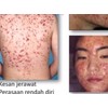 Alazo Sabun Ibu Kunyit Limau untuk hilangkan jerawat batu/ jerawat