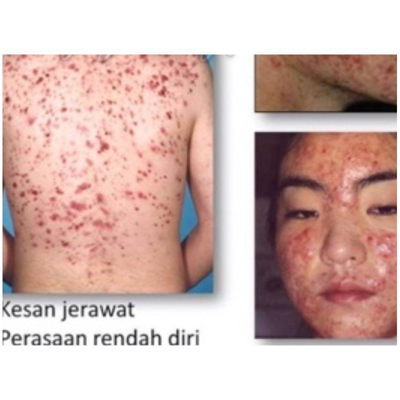 Alazo Sabun Ibu Kunyit Limau untuk hilangkan jerawat batu/ jerawat