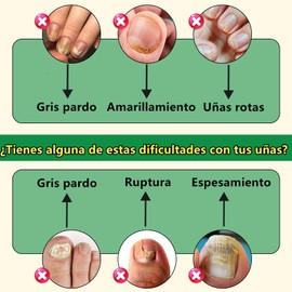 LUSCOR Ginger Nail Treatment Nail Support Nail Care，Reparación de uñas de los pies, Cuidado multiusos, Suero de jengibre para el crecimiento de las uñas, Hidrata las uñas, Repara las uñas dañadas, Agrietadas y descoloridas-2pcs