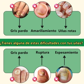LUSCOR Ginger Nail Treatment Nail Support Nail Care，Reparación de uñas de los pies, Cuidado multiusos, Suero de jengibre para el crecimiento de las uñas, Hidrata las uñas, Repara las uñas dañadas, Agrietadas y descoloridas-2pcs