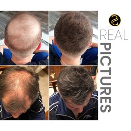 Illusya® Scatter Hair – Hair Fibres for Thickening Hair Premium brand. Full hair in seconds!