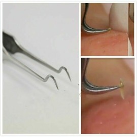 Medentra Blackhead Pimple Remover Tweezers Acne Blemish Whitehead Comedone Face Cleaner