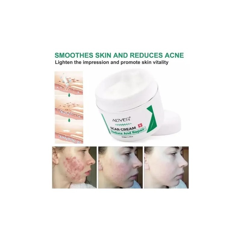 Crema Para Cicatrices, Estrías, Acné, Cacarizos Crema Repara