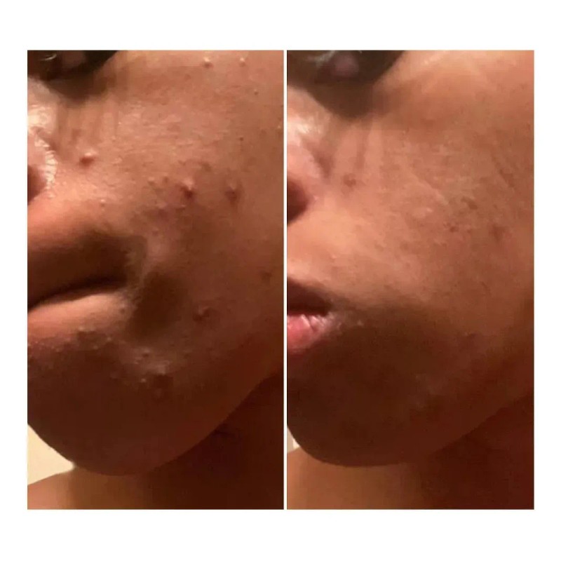 Urban Skin Rx 3-in-1 Clear Skin Cleansing Bar - 2.0oz