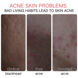 15% Azelaic Acid Acne Tratment Gel - Spot Treatment for Face - Anti Acne Gel For Spot Prone Skin - Face Gel For Pimple Reduce,Blackhead Remover - Hydrate,Bright,Smooth Skin