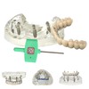 Ningfan Dental Implant Model,Implant All on 4 Overdenture Treatment Model,