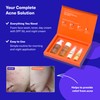 Dermz Acne Treatment - Acne Cream, SPF Face Protection, Face