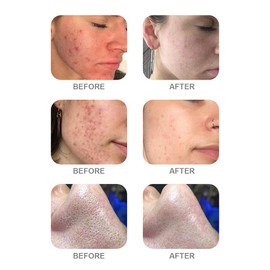 AS1 SA2 AO3 Aqua Peeling Solution Premium Salon Professional Dermabrasion Serum for Small Bubble Skin Care Facial Mask Machine (AS1 SA2 AO3, 3)