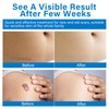 Keloid Bump Removal, Keloid Scar Treatment for Face, Body, Advanced