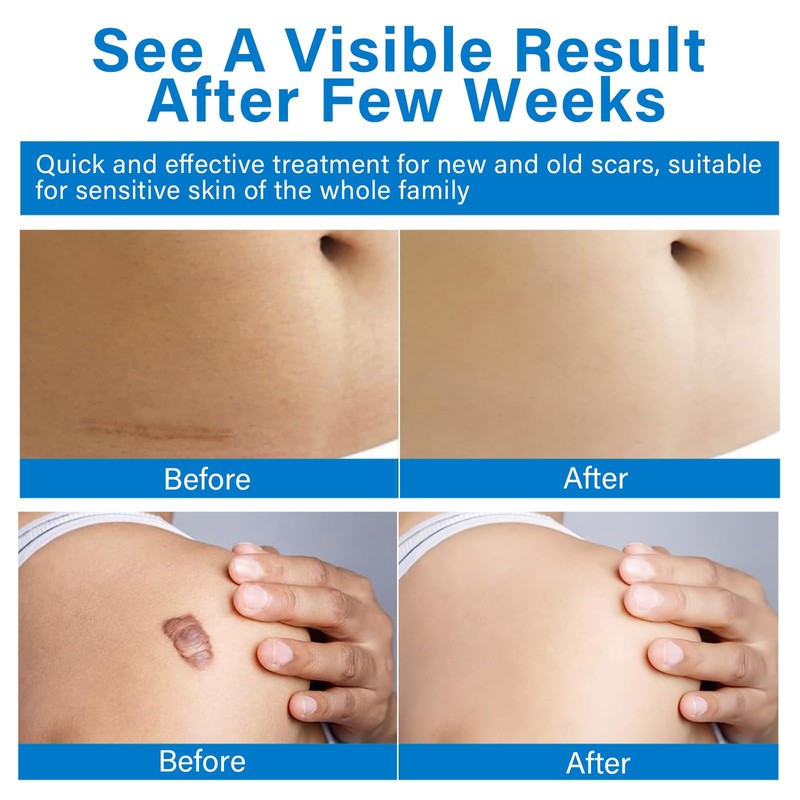 Keloid Bump Removal, Keloid Scar Treatment for Face, Body, Advanced