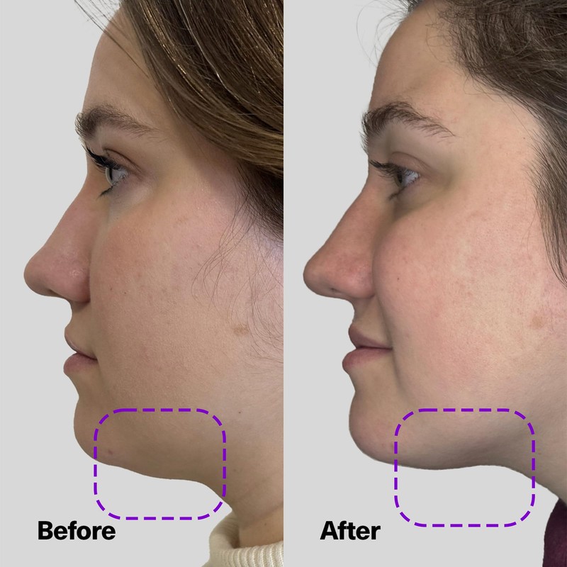 SickScience ShapeShift Jaw Defining Serum for Double Chin, Face &