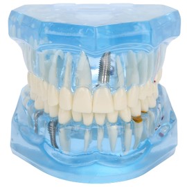 NSXAYIWE Dental Oral Typodont Model, Acrylic Blue Dental Model, Transparent Mouth Model, Dental Model, Compatible for Dental Study, Teaching, Research