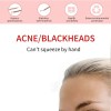 Kit Sacacomedones Remover Espinillas Y Puntos Negros 4 Pzas