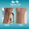 NewGel+ Advanced Silicone Professional Scar Treatment Tape for Abdomen and