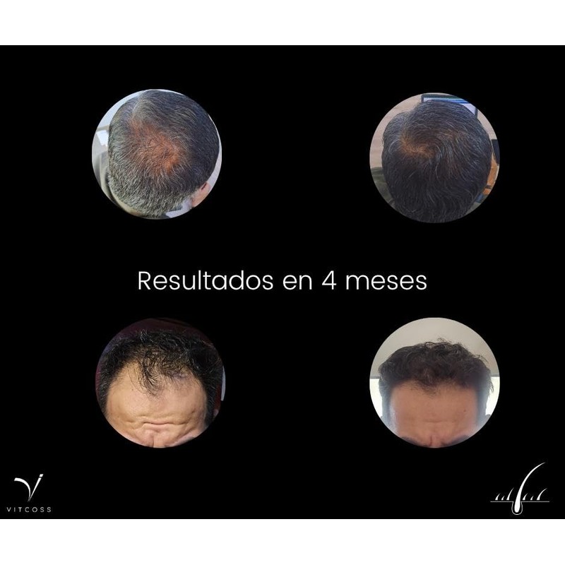 Kit anticaida capilar