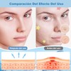 Parches para Acne,Pimple Patch,200 Almohadillas Hidrocoloides para Espinillas, Parches para