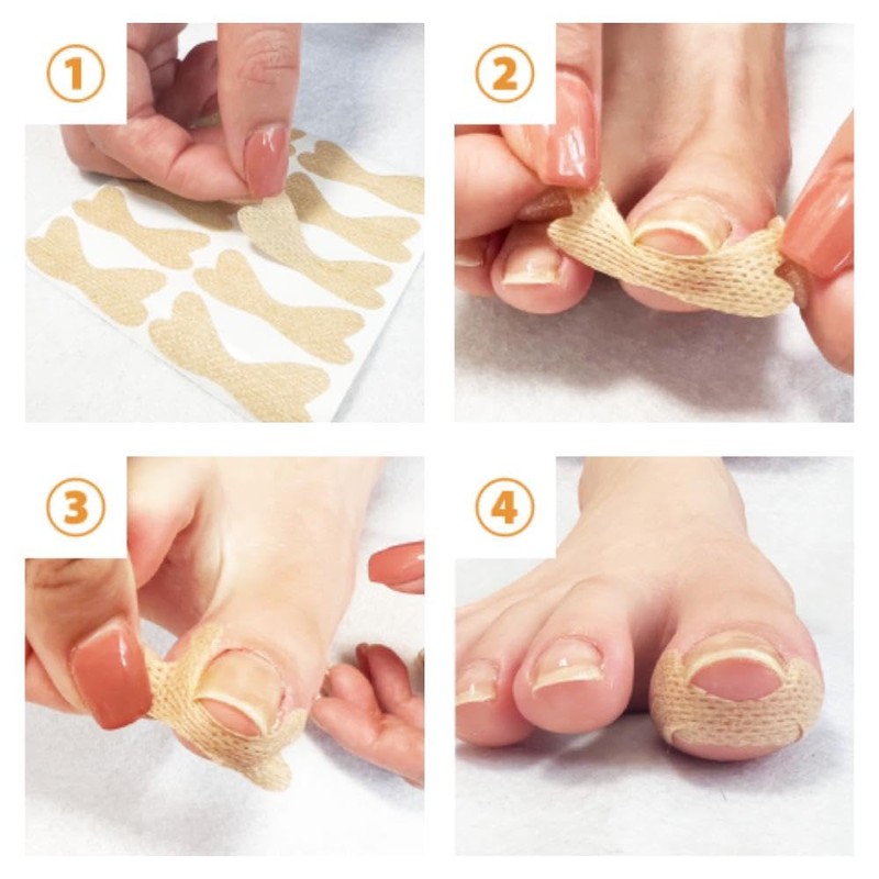 【巻き爪のプロ監修】つめらっく 巻き爪テープ《強粘着×通気性素材》カンタン貼るだけ！陥入爪 まきずめ まきづめ 巻爪 まきつめ 爪テープ[オリジナル説明書付属]足の快適工房 (はがれにくい蝶型タイプ, 100枚)