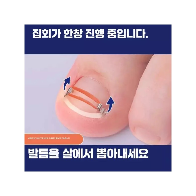 내성발톱교정기 발톱교정기 엄지발톱 내성손톱 [교정기 2개] Ingrown Toenail Correction Device,