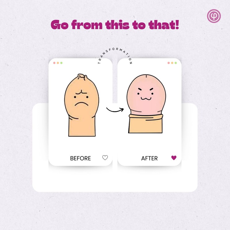 Phimosis Pro Kit with 20 x Phimosis Rings, 1 x