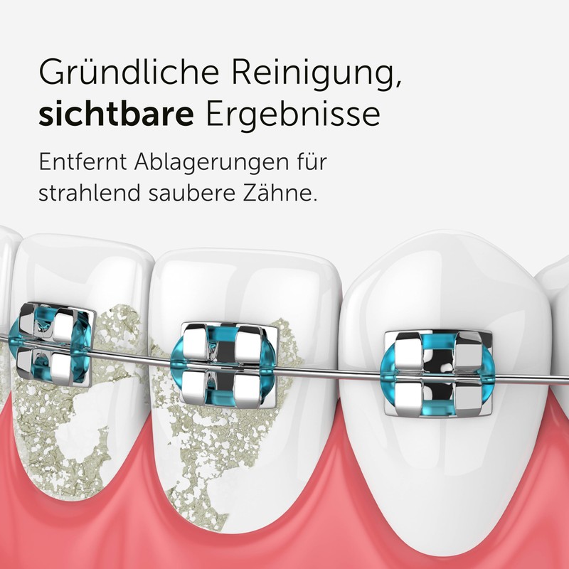 Wondersmile Orthodontic Nozzle - Replacement Nozzles for Waterflow Oral Irrigator