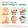 MEDLOT Silicone Scar Sheets, 1.55” x 156” - 4M, Medical