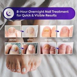 Nail Growth Treatment,Toenail And Nail Strengthener,Nail Treatment,Nail Repair,Nail Repair Treatment,Fix & Renew Damaged, Broken Nails,Toe Nail Treatment,Broken Nails,Yellow Toenail Treatment