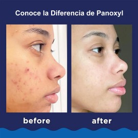Harmei 2pcs Gel Limpiador Antiacné Panoxyl (156g*2) Benzoyl Peroxide 10%, Antibacterial Potente, Apto Para Rostro Y Cuerpo, Elimina El Acné Existente Y Ayuda A Prevenir Nuevos Brotes