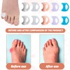 10 Pcs Zehenspreizer Kleiner Zeh,Zehentrenner Silikon,Silikon Gel Kleiner Zeh Hallux