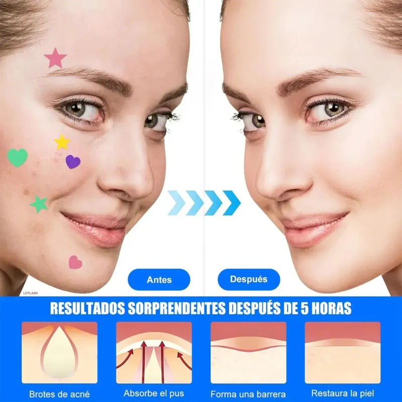 Cyrene Parches Estrella Star Anti Acne Espinillas Granos Fac Normal