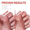 Probelle Nail Strengthener, Nail Strengthening Treatment, Nail Growth and Repair,