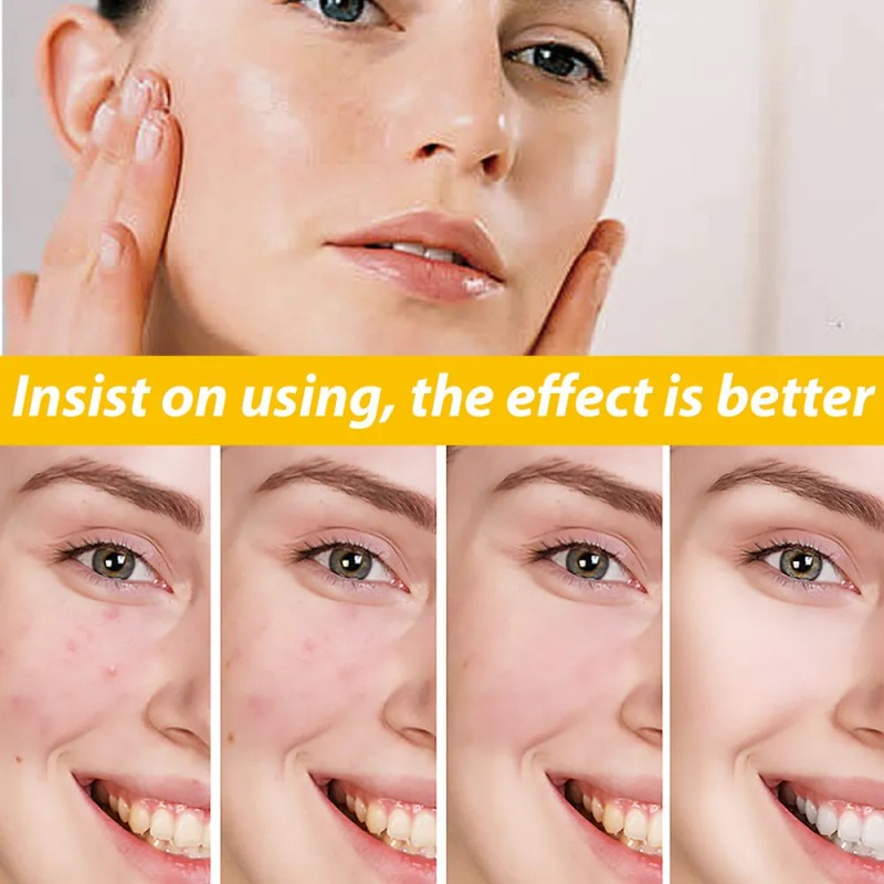 3×crema Para Tratar El Acné: Combate Acné Hormonal Quístico
