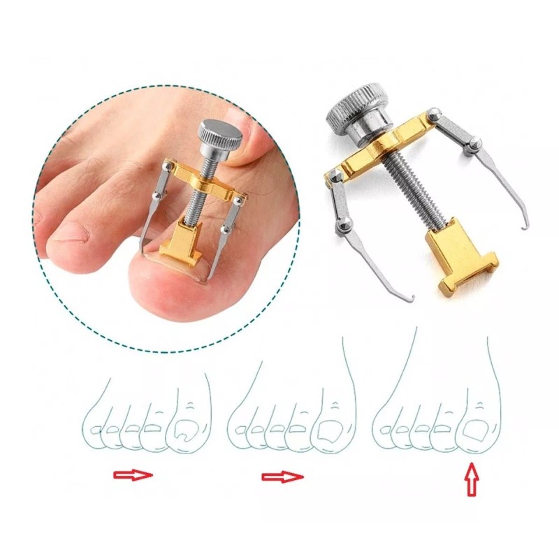 Universo en Linea Kit Corrección Uñas Enterradas Corrector Uñas Encarnadas