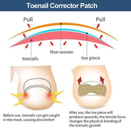 Toenail Patch, Toenail Correction Patch, Ingrown Toenails Correction Patch, Ingrown Toenails Patch, Correction Sticker Toe Nail Pack of 60