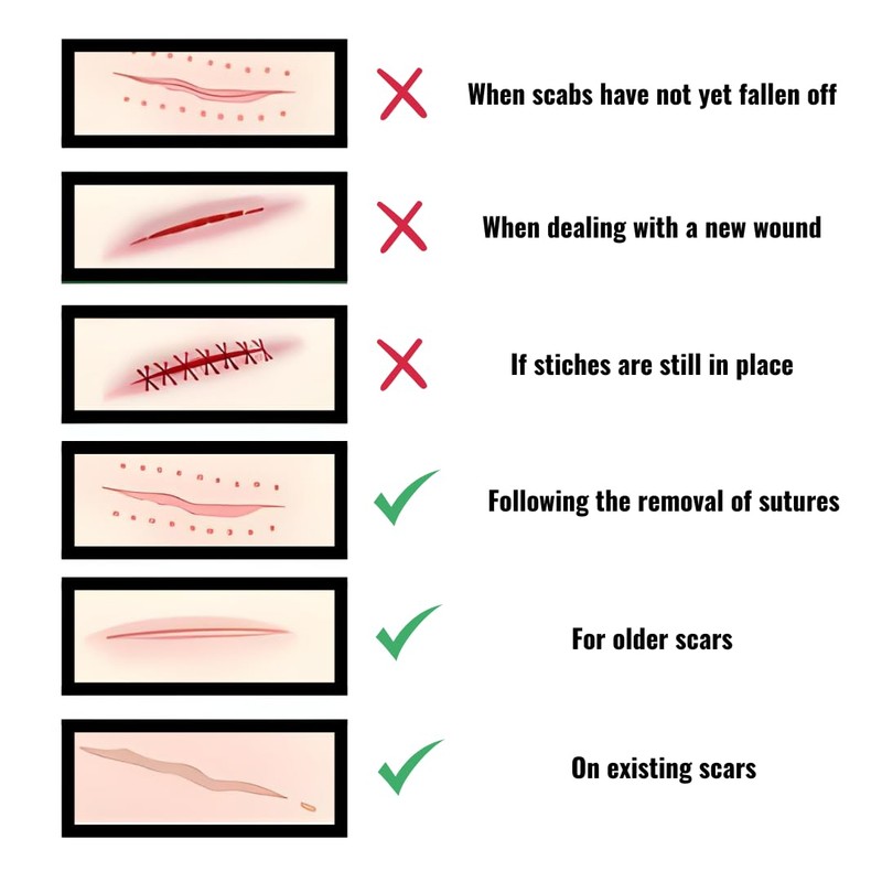 NIEGON Professional Silicone Scar Tape (1.6" x 60") - Scar