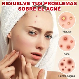 180pzs Parches Pegatinas Para Acné Absorbentes Pimple Patch