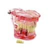 Global-Dental Removable Implant Studying Analysis Demonstration Teeth Model with Restoration