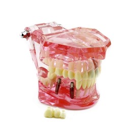 Global-Dental Removable Implant Studying Analysis Demonstration Teeth Model with Restoration