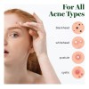 Cover Healing Invisible Acne Patch Blemish Spot, Treatment,