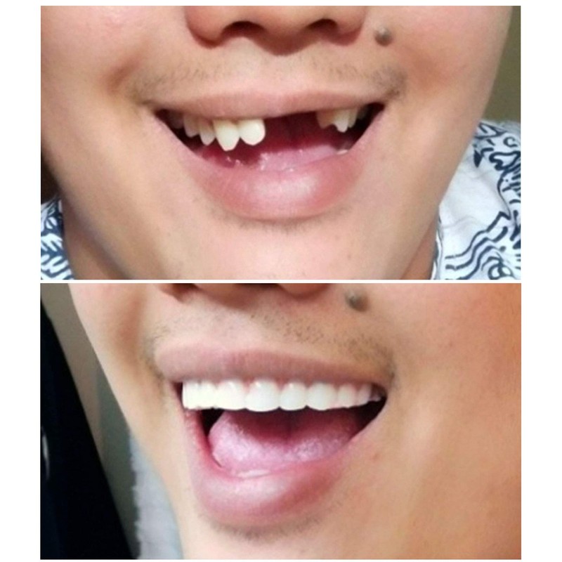 Instant Smile Comfort Fit Flex - Bright Shade - Upper