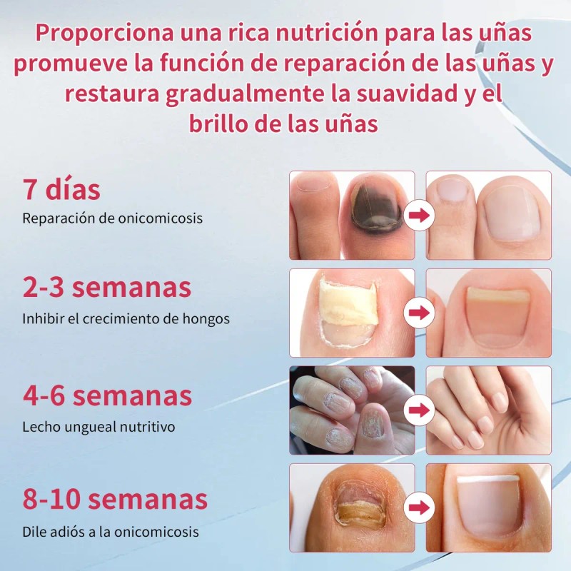 Líquido Para Hongos En Las Uñas Tratamiento Efectivo 50ml