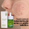 Suero Tratamiento Acné Ácido Salicílico Cuidado Facia 30ml F