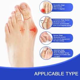 Hallux Valgus Toe Corrector Toe Separator Bunion Splint 【2025 Updated】 Bunion Corrector Kit Bunion Corrector Set Bunion Brace Bunion Exercise Belt Orthopedic Kit Inflamed
