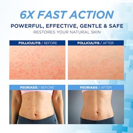 Hermon- Crema para el tratamiento de la foliculitis: tratamiento eficaz para la foliculitis del cuero cabelludo, rostro y cuerpo 100 g