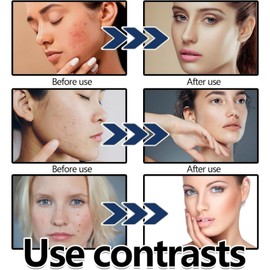 Acne Foam Wash,Acne Foaming Wash,Exfoliating Face Rinse,Mild Daily Facial Cleanser for Deep Pore Cleansing,Gentle Facial Cleansing,Foaming Clean,Hydrating Cleanser,Deep Pore Clean,Froth Face Rinse