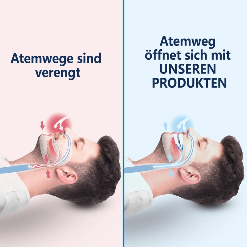 Dabeto Snoring & Protrusion Splint, Anti Snoring Stopper, Anti Snoring