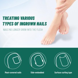 Ingrown Toenail Treatment, 60Pcs Breathable Ingrown Toenail Strips, Professional Pedicure for Ingrown Toenail, Toenail Corrector Patch,Painless ingrown nail removal.