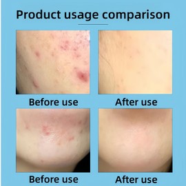 Acne Control Cream for Face,Acne Treatment Gel,A-cne Treatment,A-cne Face Cream,Ac-ne Gel Fast Absorbing Spot T-reatment,Anti Ac-ne F-ace C-ream,Acn-e C-ream for F-ace,Fa-ce Acn-e T-reatment